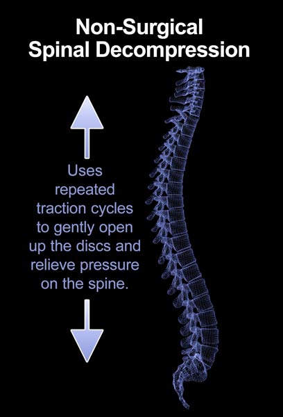 Non-Surgical Cervical Spine Decompression in Cleburne Texas. 